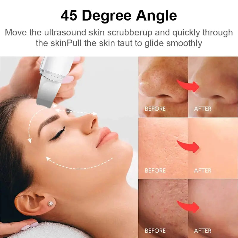 Ultrasonic Skin Scrubber Vibration Face Spatula Blackhead Remover Shovel Clean Cavitation Peeling Facial Lifting Skin Care Tools Vibes