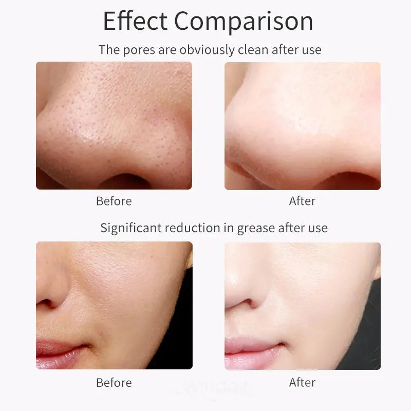 Ultrasonic Skin Scrubber Vibration Face Spatula Blackhead Remover Shovel Clean Cavitation Peeling Facial Lifting Skin Care Tools Vibes